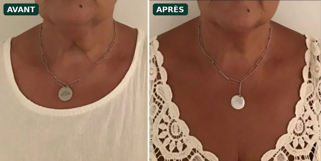 Lifting du cou sans chirurgie par HIFU : avant / après sur le cou et le double menton