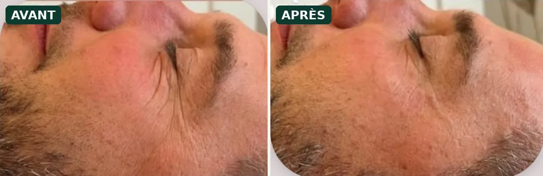 HIFU avant / après sur le regard : effet liftant sur le haut du visage